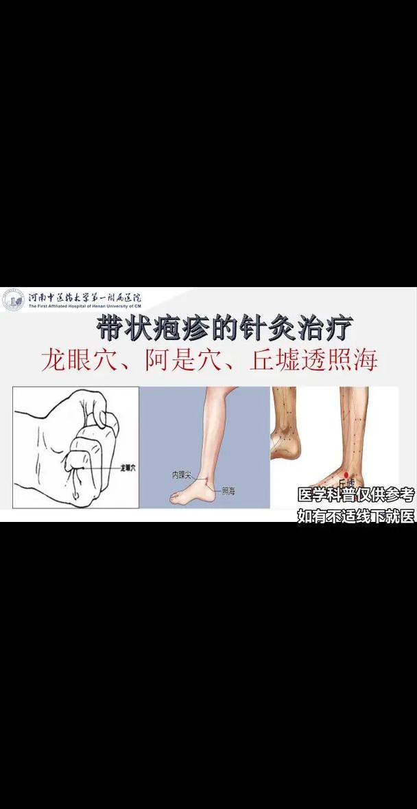 带状疱疹能用针灸治疗