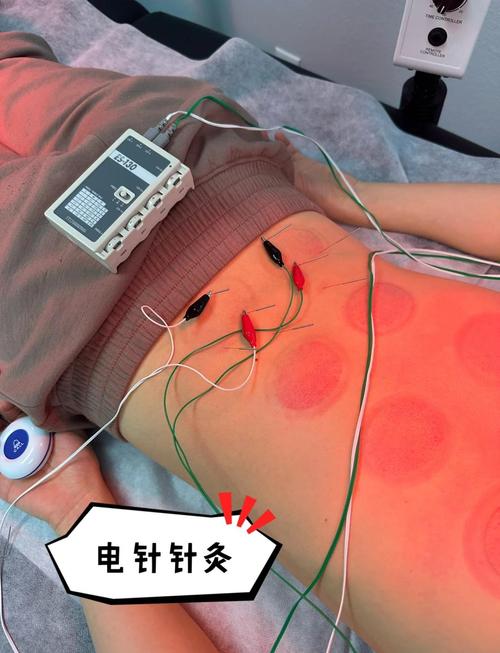 针灸治腰痛多少天有效