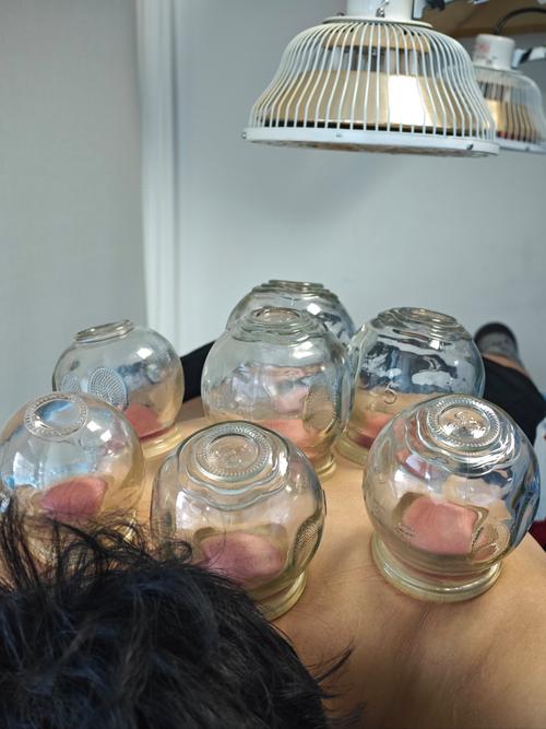 针灸拔火罐可以减肥吗