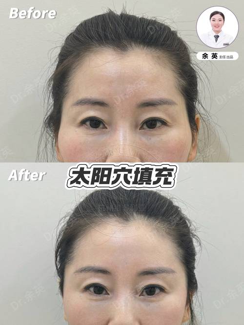 玻尿酸填充太阳穴安全吗