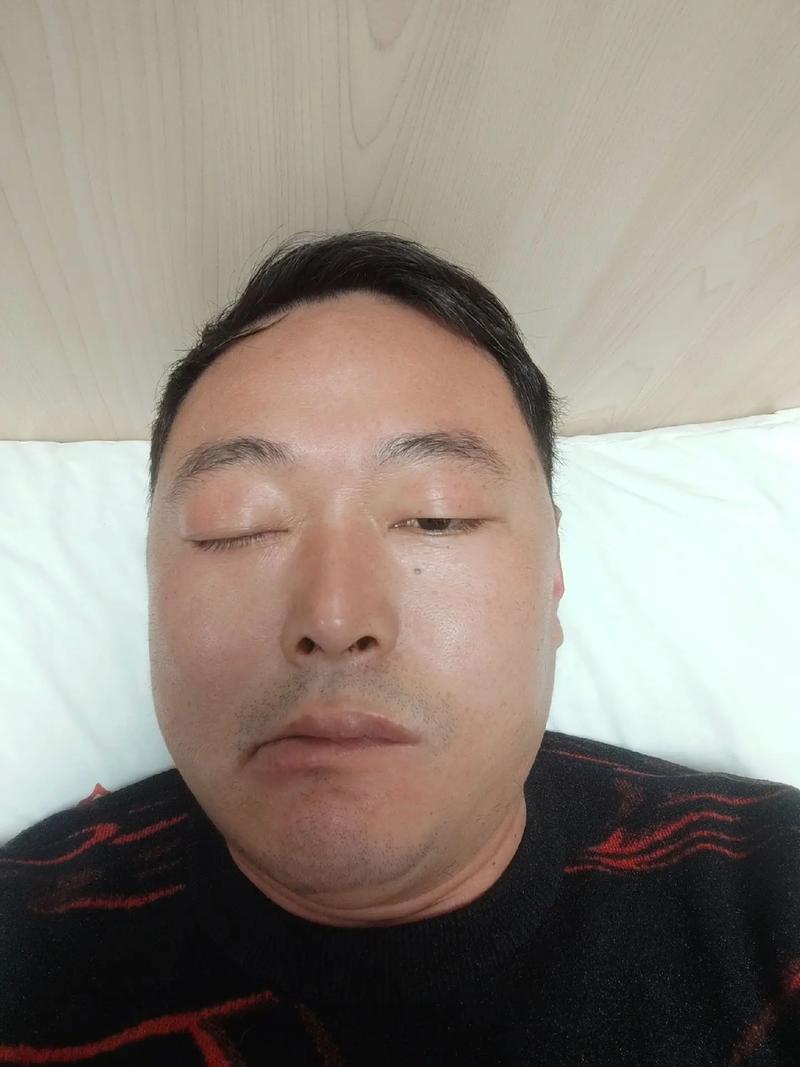 面瘫做了针灸后脸肿了