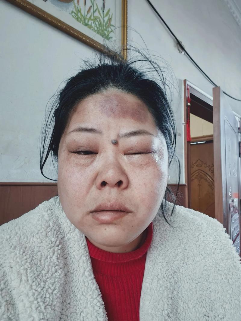 面瘫做了针灸后脸肿了