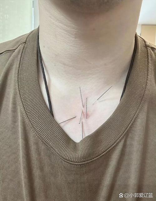 针灸气胸能鉴定出来吗