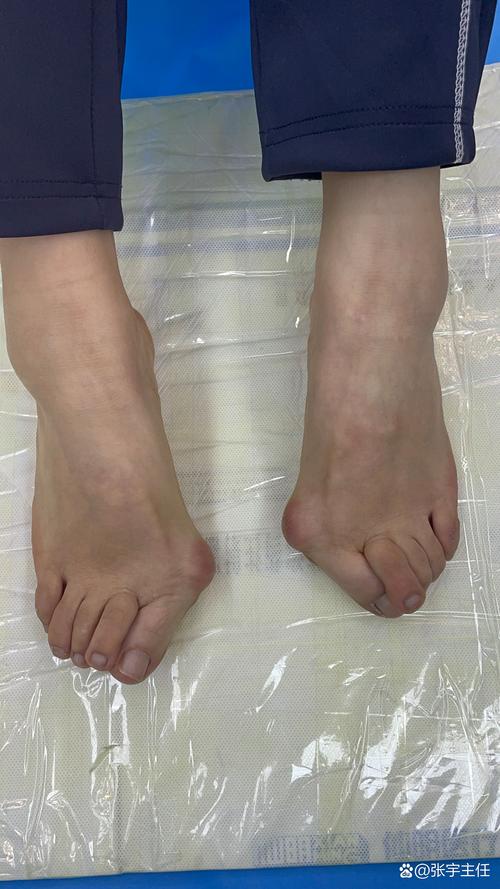 大母脚趾外翻是痛风吗