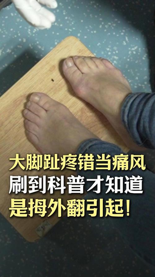 大母脚趾外翻是痛风吗