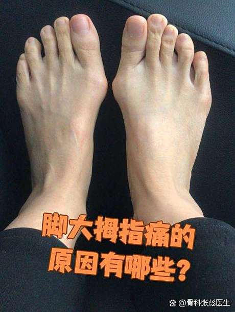 大母脚趾外翻是痛风吗