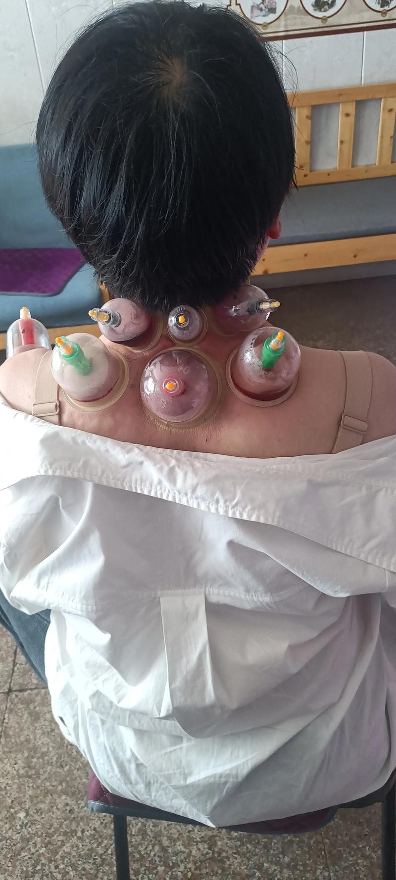 苏州哪里可以针灸拔罐