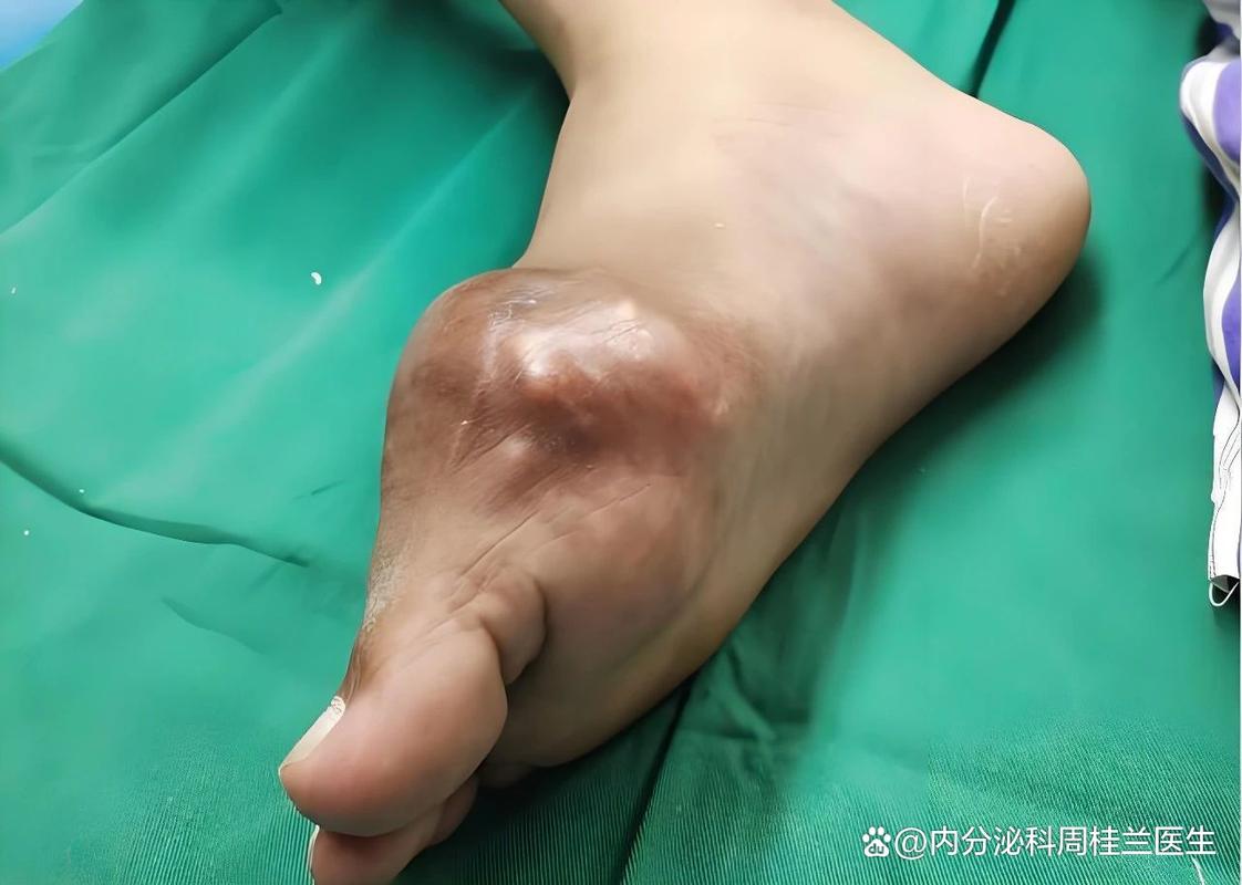 痛风溶晶后还会复发吗