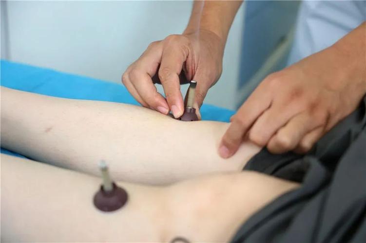 针灸对尿潴留治疗方法