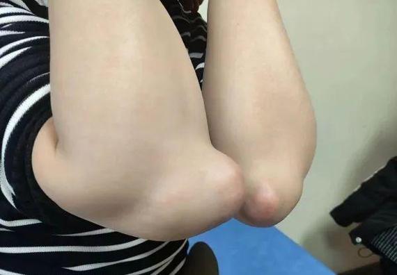 手肘突出是痛风前兆吗