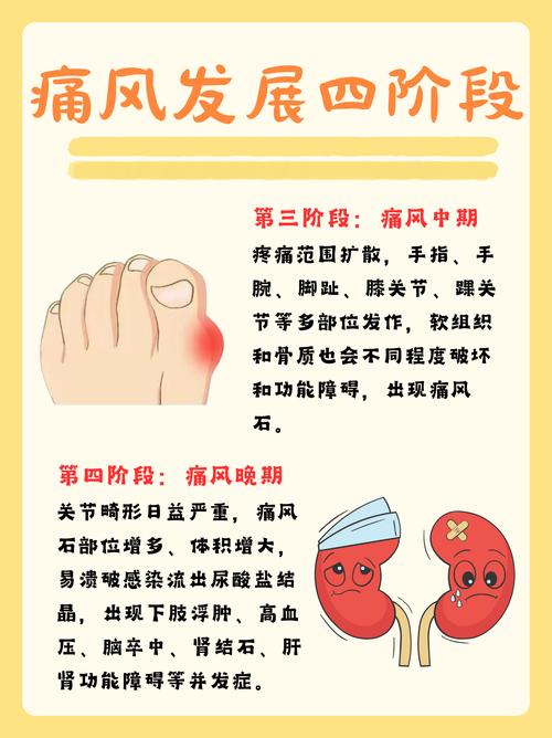 痛风中期到晚期要多久