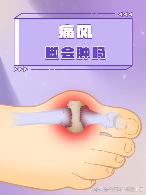 痛风排酸期为什么疼痛