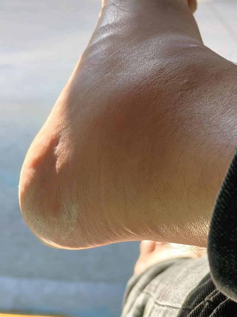 痛风脚踝里面一直颤抖