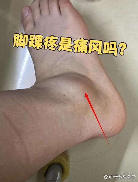 痛风脚踝里面一直颤抖