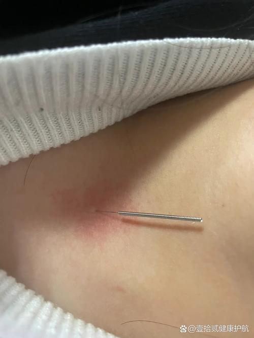 中医针灸治疗慢性咽炎