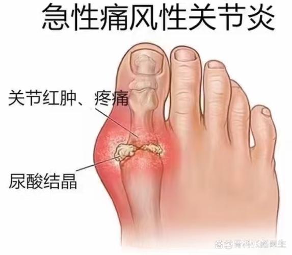 大脚趾疼是痛风初期吗