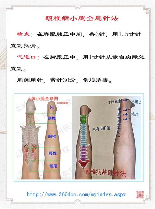 全息针帕金森针灸治疗