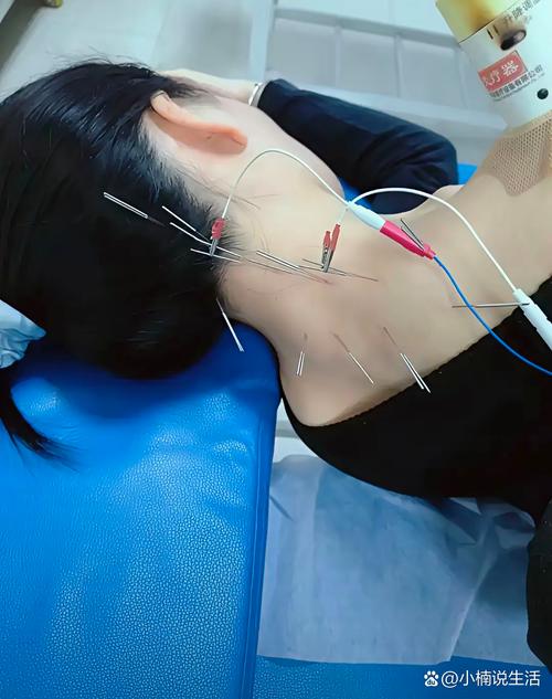 针灸甲状腺结节扎后背