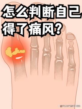 脚趾肿痛一定是痛风吗