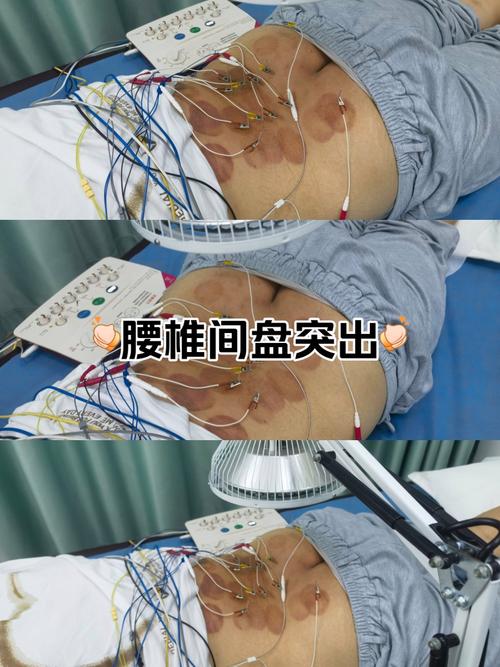 腰酸针灸多久可以恢复