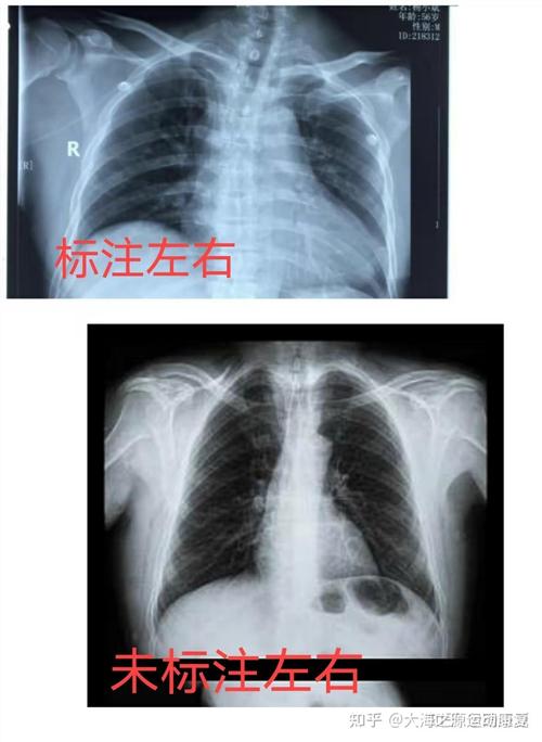 CT一年做几次是安全的