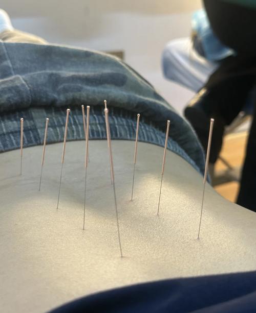 腰肌劳损针灸治疗方法