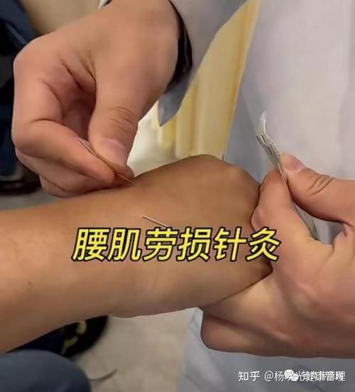 腰肌劳损针灸治疗方法