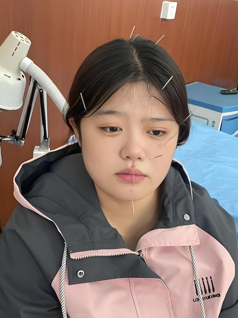 小孩面瘫直接针灸好吗