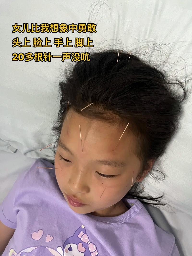 小孩面瘫直接针灸好吗