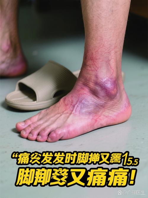 痛风好后总感觉不舒服