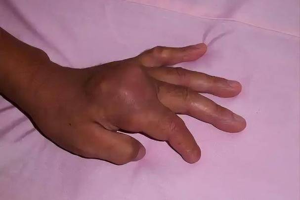 痛风时间长了会死人吗