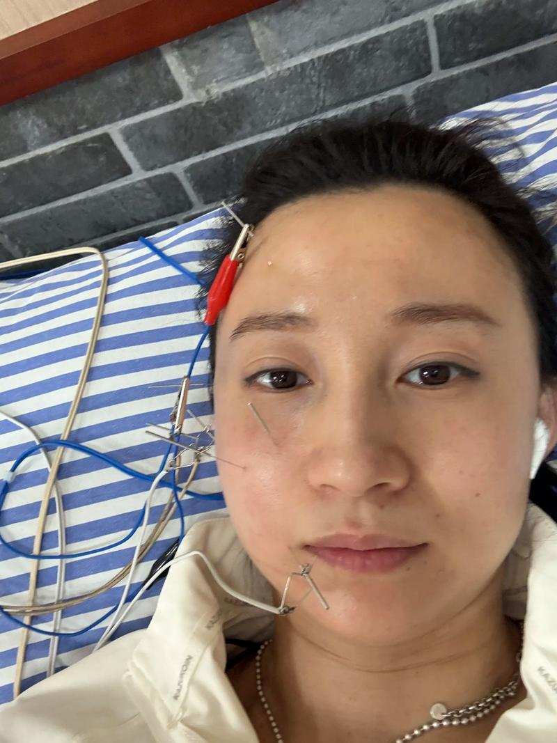 面瘫面部可以针灸治疗