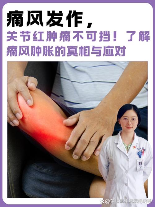 痛风发作红肿怎么治疗