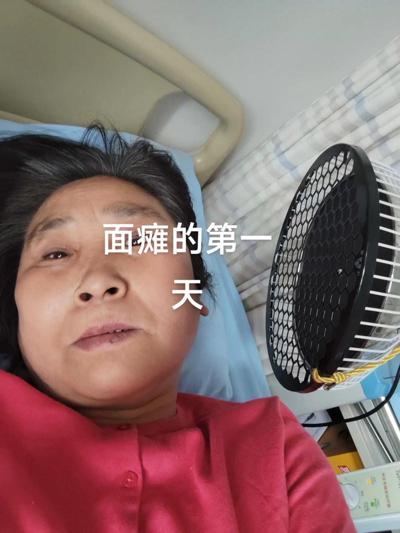 轻度面瘫针灸多久会好