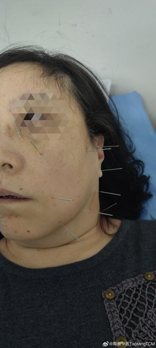 针灸治疗面瘫效果好吗