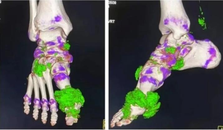 双源ct能确诊痛风吗