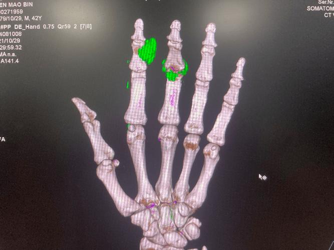 双源ct能确诊痛风吗