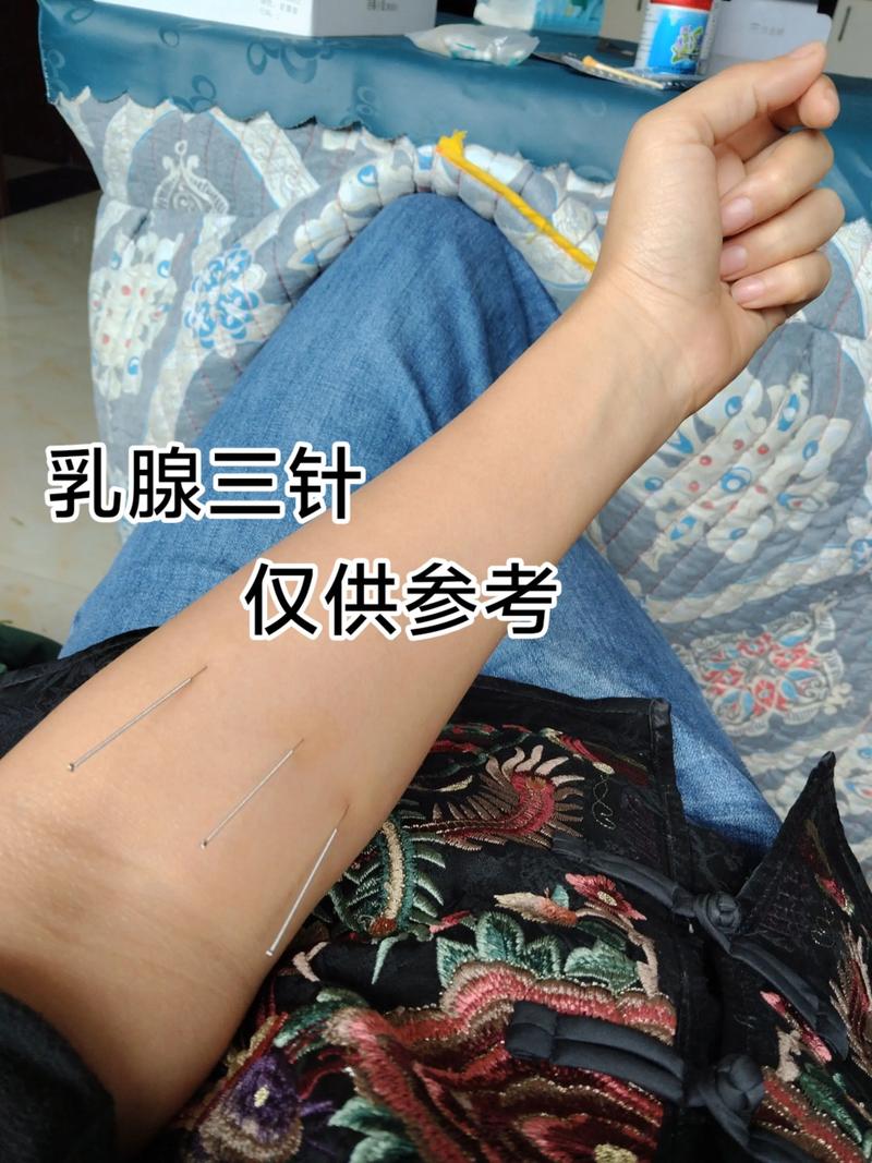 哪里可以中医针灸丰胸