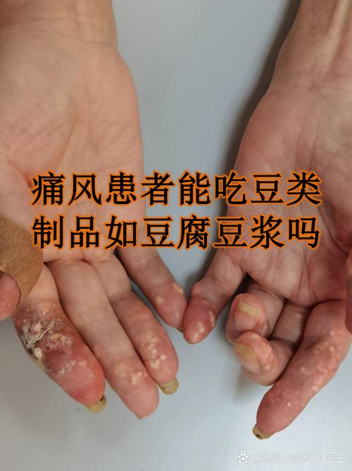 痛风患者能吃大豆腐吗