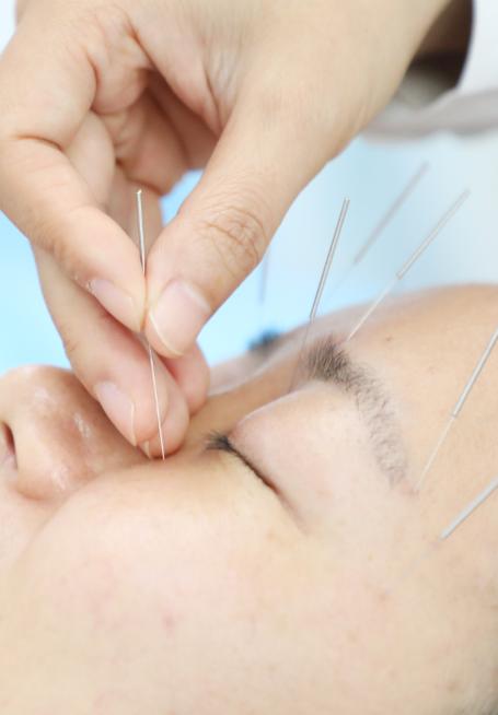 针灸可以治疗干眼症吗