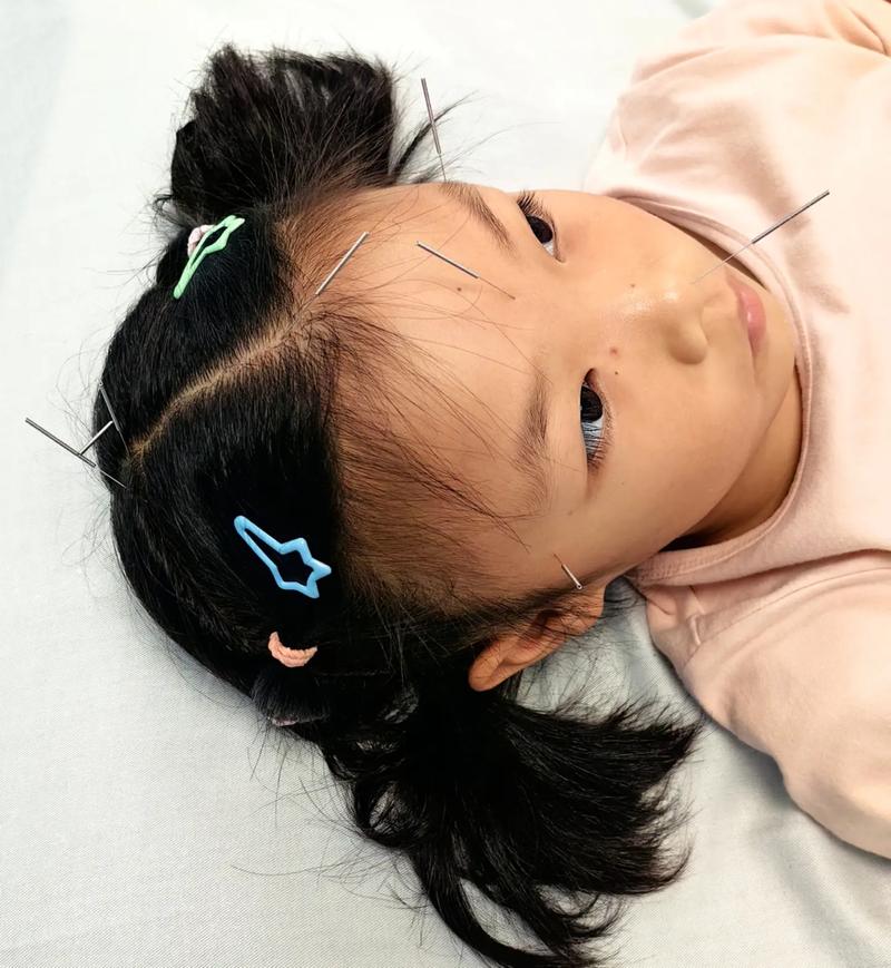 齐齐哈尔哪里针灸小孩