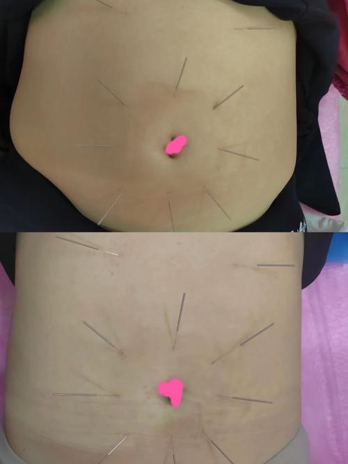 腹部硬结 点按 针灸