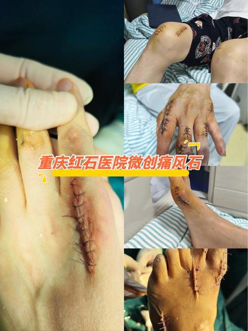 天津哪个医院看痛风好