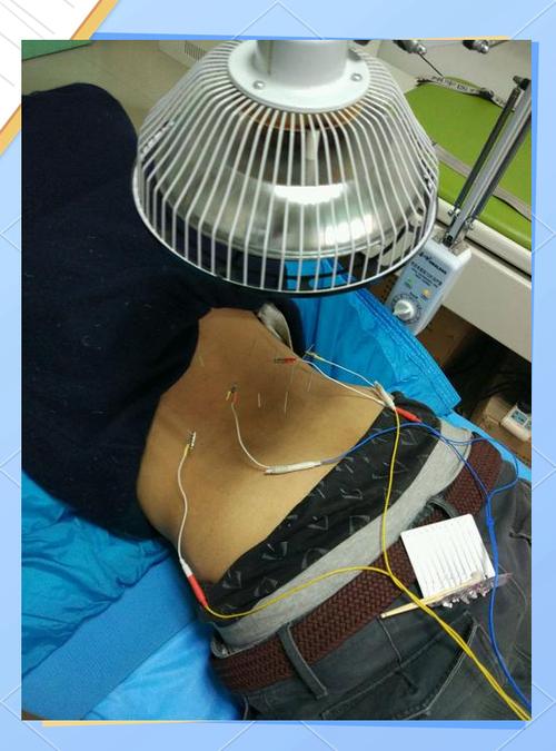 针灸腰间盘突出好不好