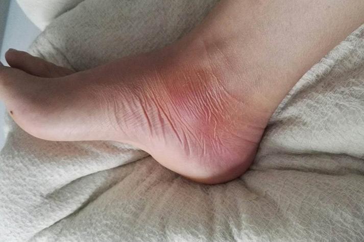 痛风好了脚上就出水泡