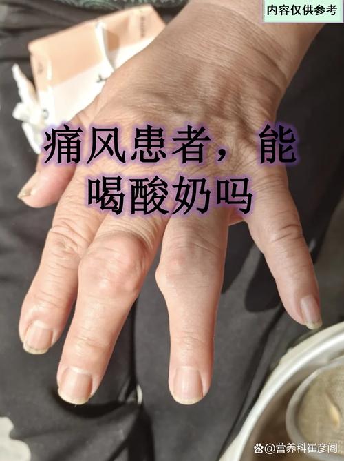 痛风患者喝什么牛奶好