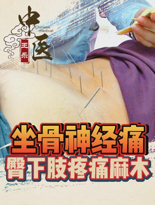 针灸能治疗坐骨神经痛