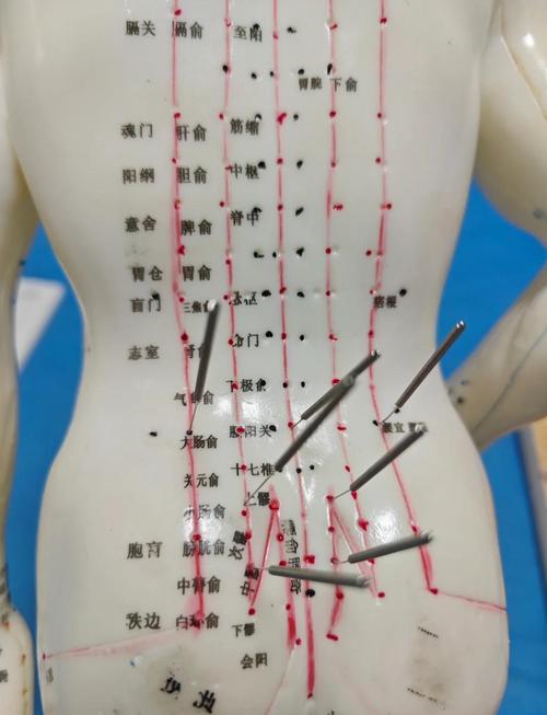 强直性脊柱炎针灸穴位