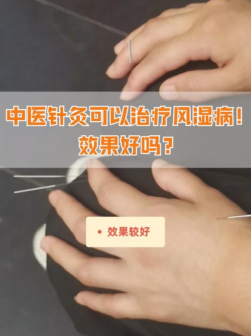 风湿性关节炎可以针灸