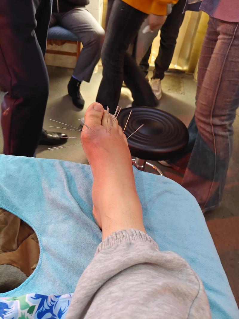 风湿性关节炎可以针灸